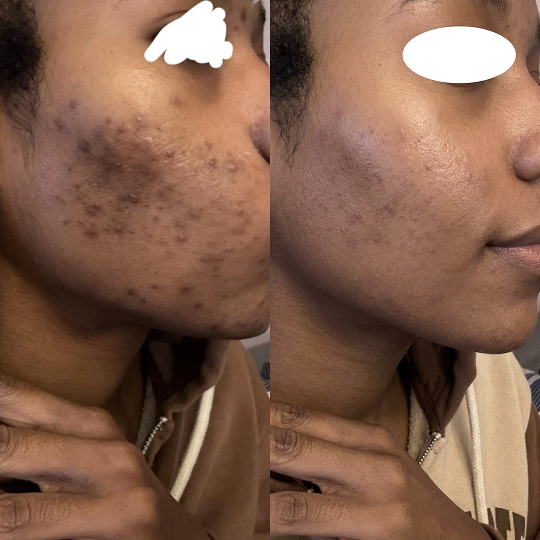 Solira Dark Spot Corrector
