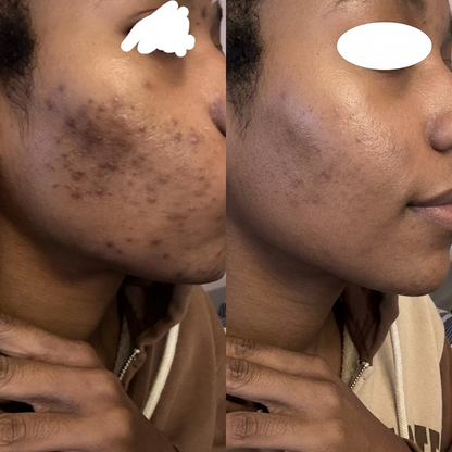 Solira Dark Spot Corrector